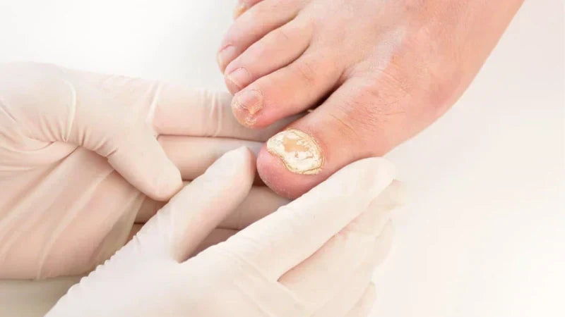 how to cure fungal nail infection?