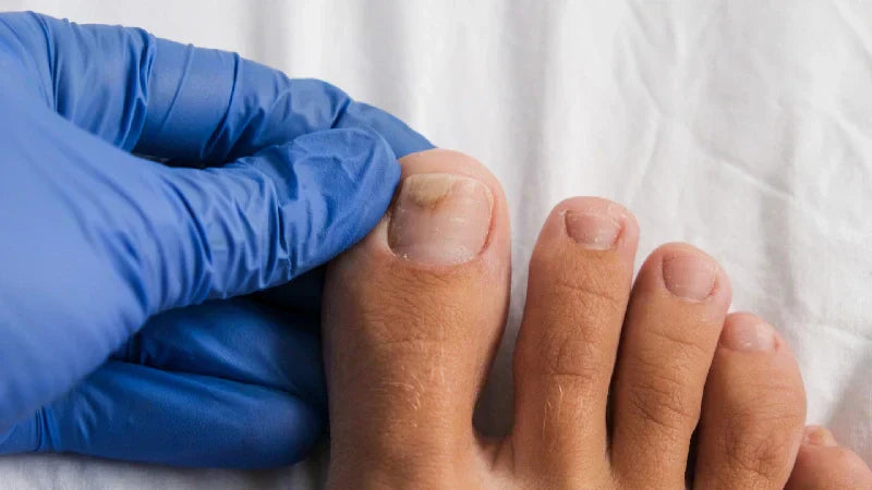  Best Supplements for Fungal Infections