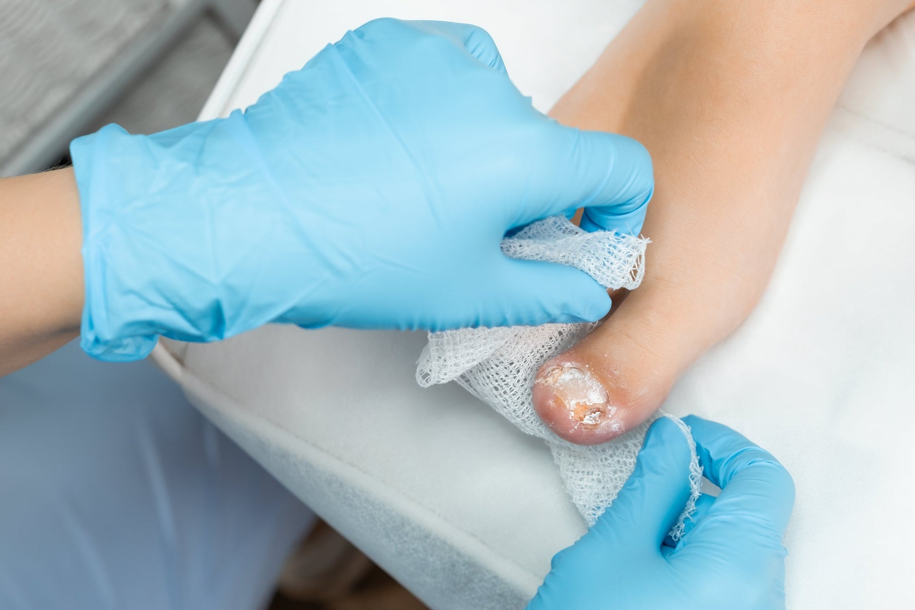 What are the stages of toenail fungus?