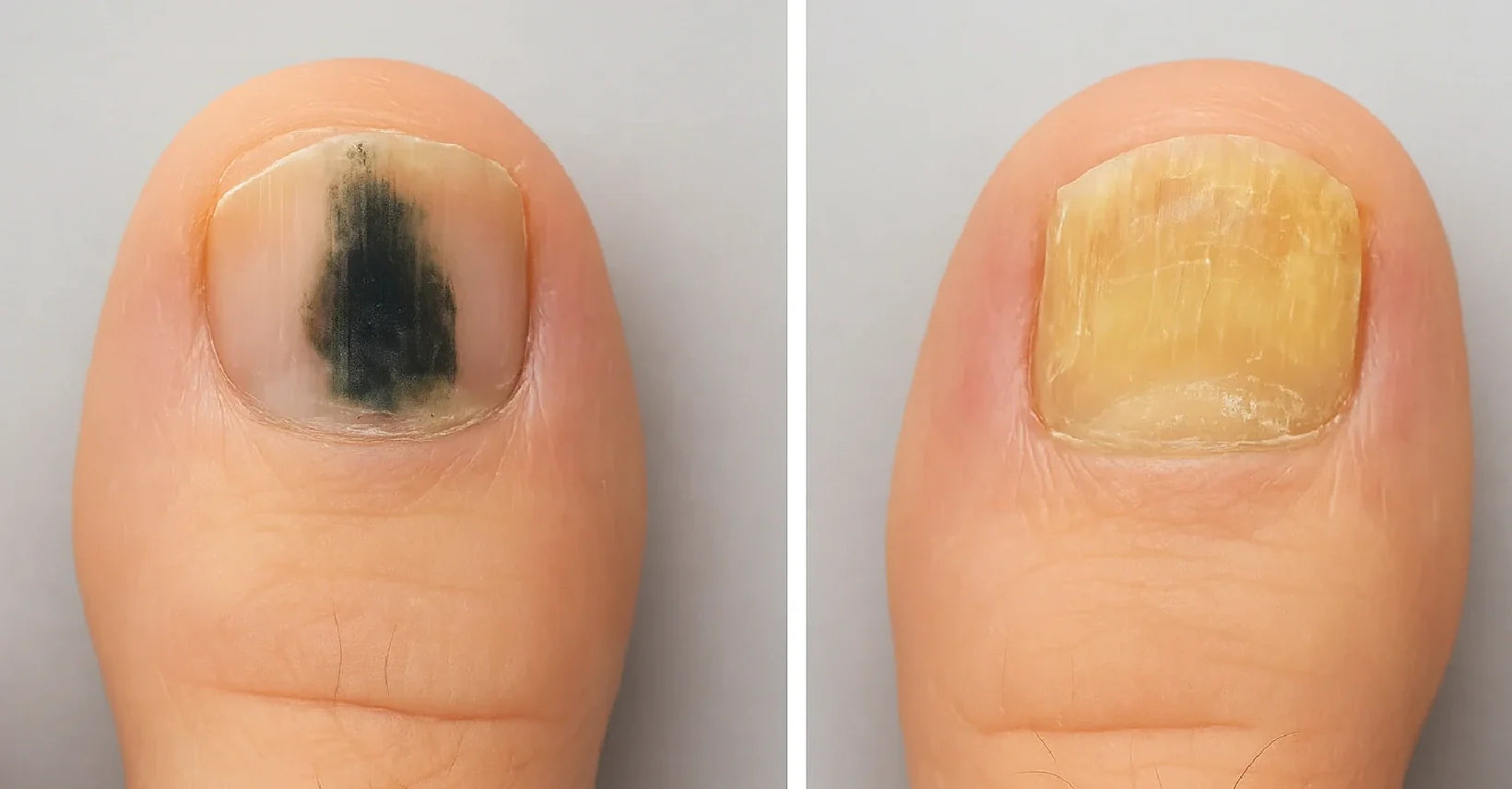 Nail Mold vs Fungus